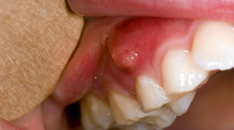 Việc chữa áp xe răng sớm sẽ giúp cho người bệnh khôi phục sức khỏe nhanh chóng