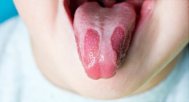Nấm lưỡi bản đồ là tình trạng viêm lành tính trên bề mặt lưỡi