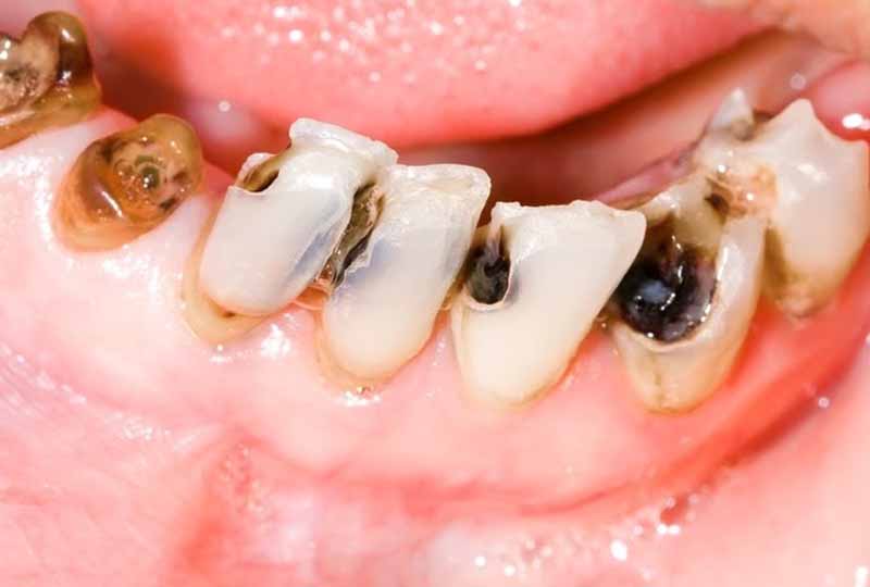 Sâu răng là một trong những nguyên nhân chính làm răng bị đau