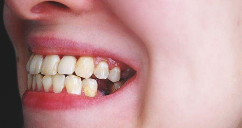 Nhổ răng là phương pháp điều trị áp xe cho bệnh nhân ở thể nặng