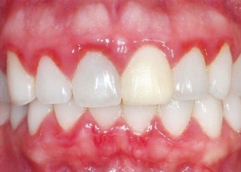Các phương pháp điều trị viêm nướu răng