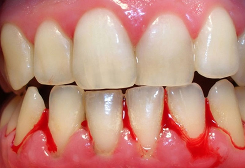 Sâu răng có mủ là tình trạng sâu răng diễn biến nặng, tiềm ẩn nhiều nguy cơ
