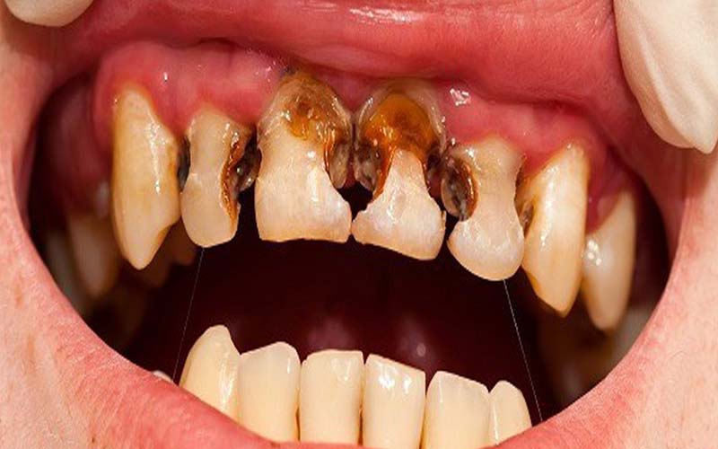 Tình trạng ê buốt răng có thể xảy ra do nguyên nhân sâu răng