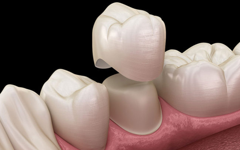 Bọc răng sứ là một trong số liệu pháp nha khoa được chỉ định để ngăn chặn tình trạng ê buốt răng hàm