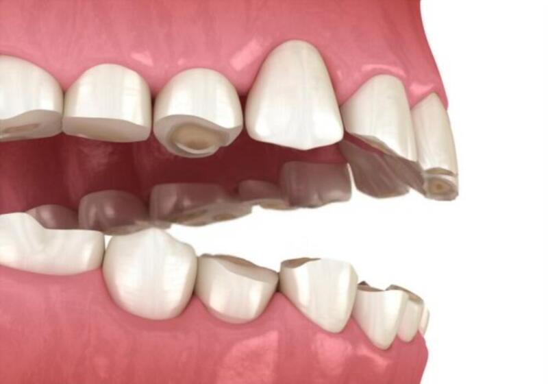 Việc người bệnh bị mòn men răng thường gặp ở cổ răng, kẽ răng nên tạo cảm giác bị ê buốt