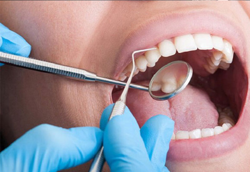 Nếu như vôi răng quá nhiều và lan xuống nướu, các bác sĩ sẽ phải tác động đến phần mô mềm để loại