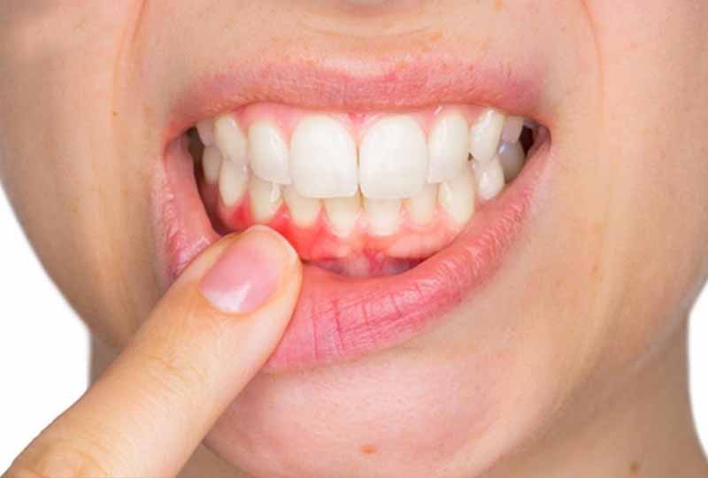 Những người mắc các bệnh lý răng miệng hơi thở thường có mùi hôi khó chịu