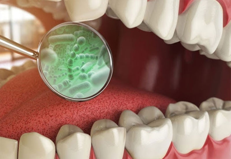 Hôi miệng chủ yếu là do vệ sinh răng miệng kém và một số bệnh lý răng miệng khác