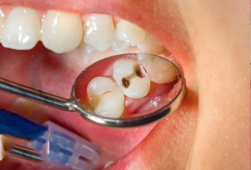 Hôi miệng sâu răng là tình trạng răng miệng khá phổ biến hiện nay