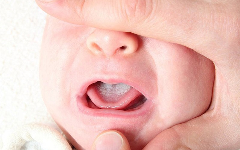 Dấu hiệu nhận biết bệnh nấm miệng là việc xuất hiện các mảng màu trắng, vàng hoặc kem trên niêm mạc lưỡi, môi hoặc phía bên trong má