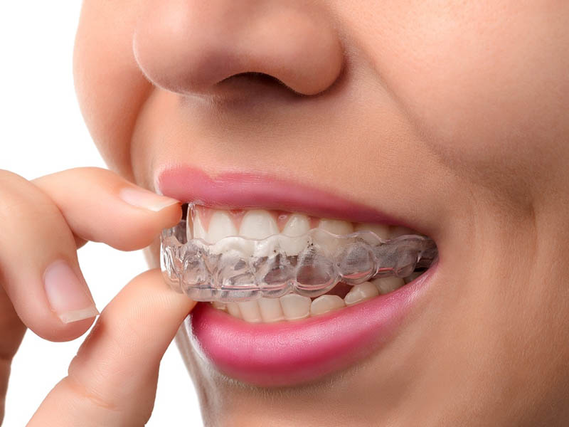 Niềng răng khấp khểnh là phương pháp dùng các khí cụ nha khoa để điều chỉnh hàm răng mọc chồng chéo, sai lệch
