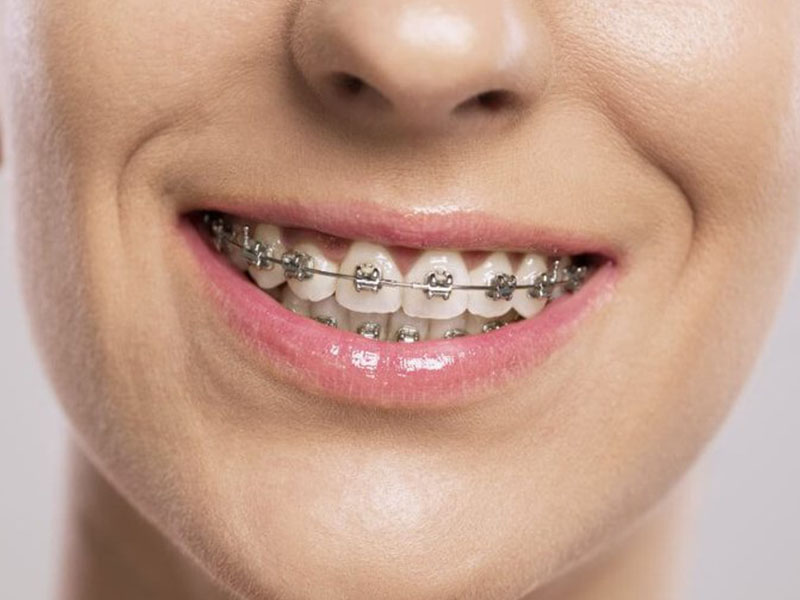 Sử dụng mắc cài kim loại là phương pháp niềng răng khểnh hiệu quả