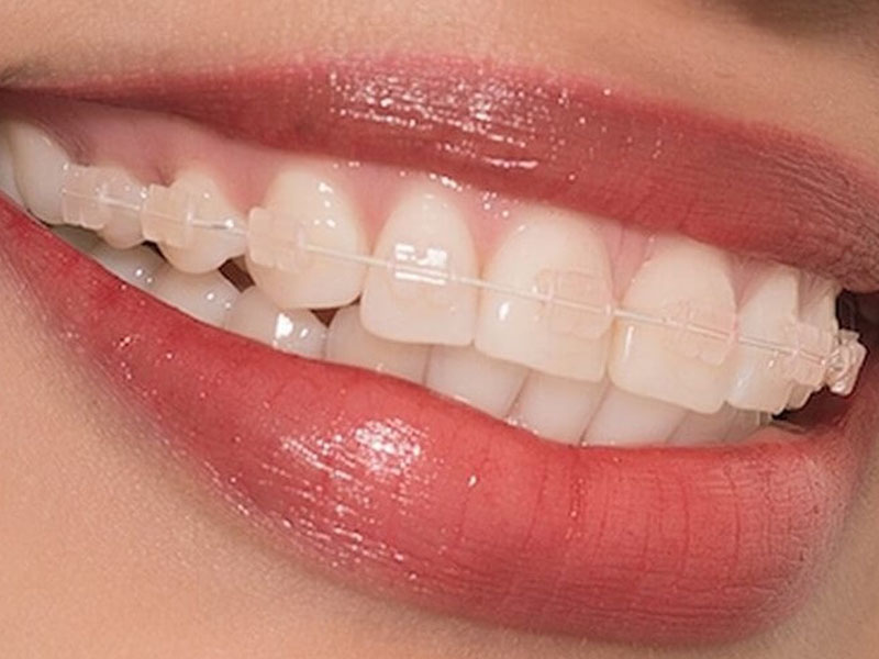 Mắc cài sứ có màu giống với màu răng thường nên phương pháp có tính thẩm mỹ cao