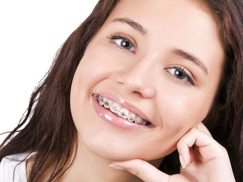 Thời gian niềng răng phụ thuộc vào tình trạng sai lệch của từng người