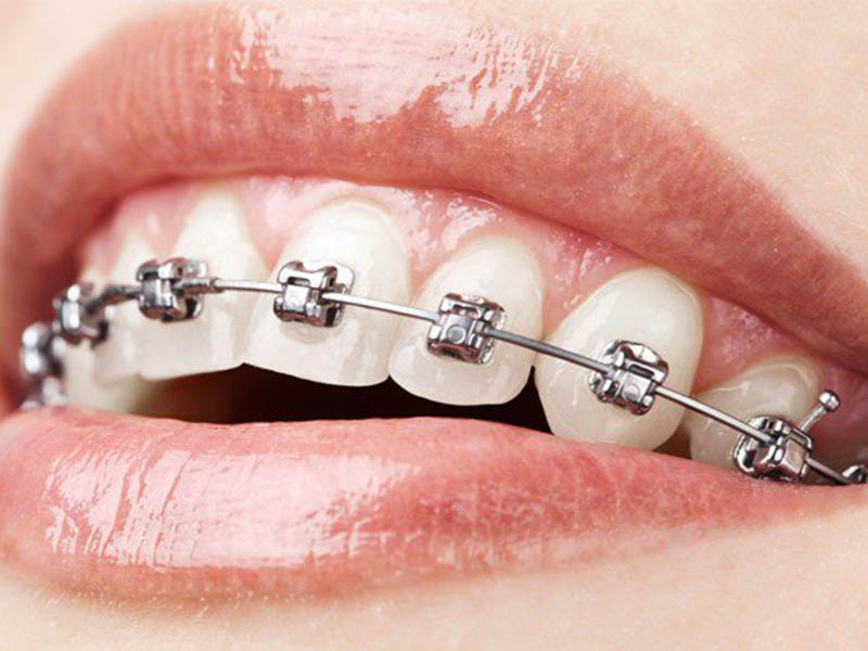 Niềng răng mắc cài kim loại là phương pháp được nhiều người lựa chọn nhất hiện nay