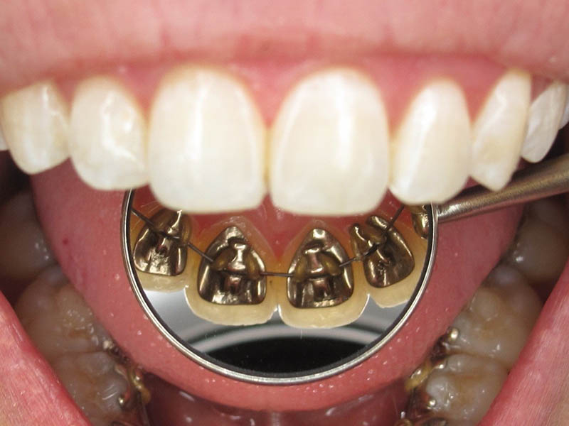 Niềng răng mắc cài mặt trong là thủ thuật nha khoa sử dụng các mắc cài kim loại gắn vào thân răng mặt phía trong