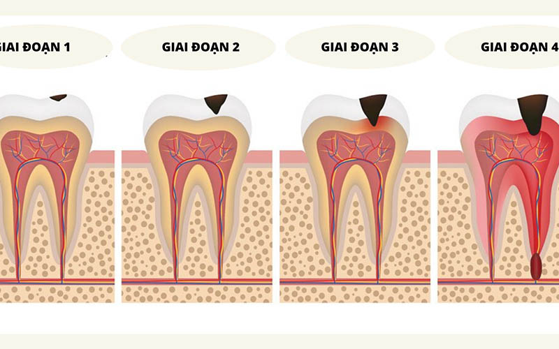 Quá trình sâu răng diễn ra theo 4 giai đoạn