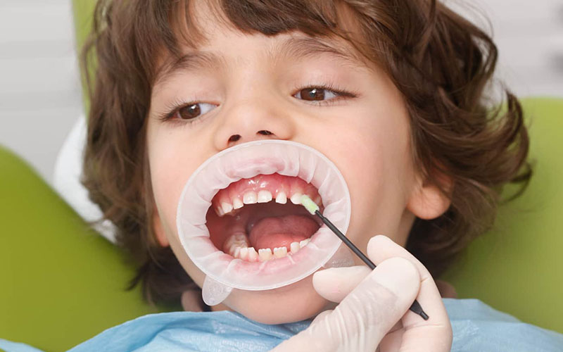 Phương pháp điều trị sâu răng giai đoạn đầu thường là sử dụng Florua