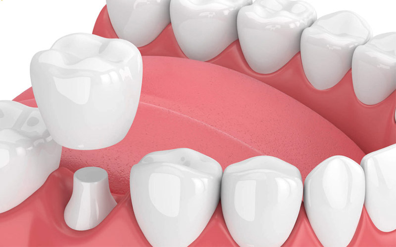 Quá trình sâu răng giai đoạn 3 được ngăn chặn bởi phương pháp bọc răng sứ