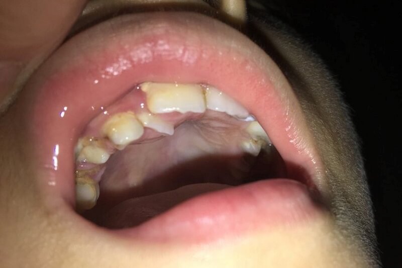 Hình ảnh minh hoạ trường hợp trẻ bị mọc lẫy răng khiến răng vĩnh viễn mọc lệch