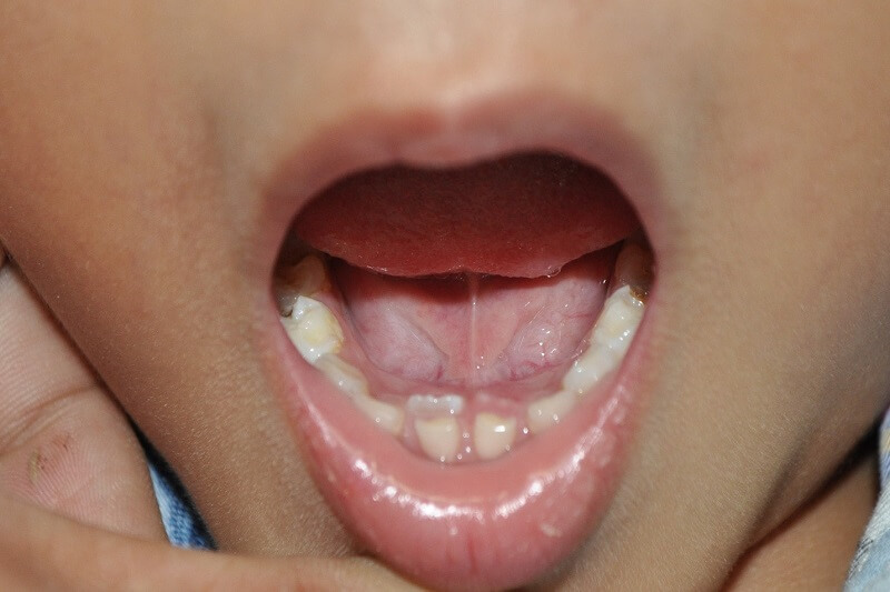 Khi trẻ bị mọc lẫy răng cần nhổ răng sữa để lấy không gian cho răng vĩnh viễn mọc lên