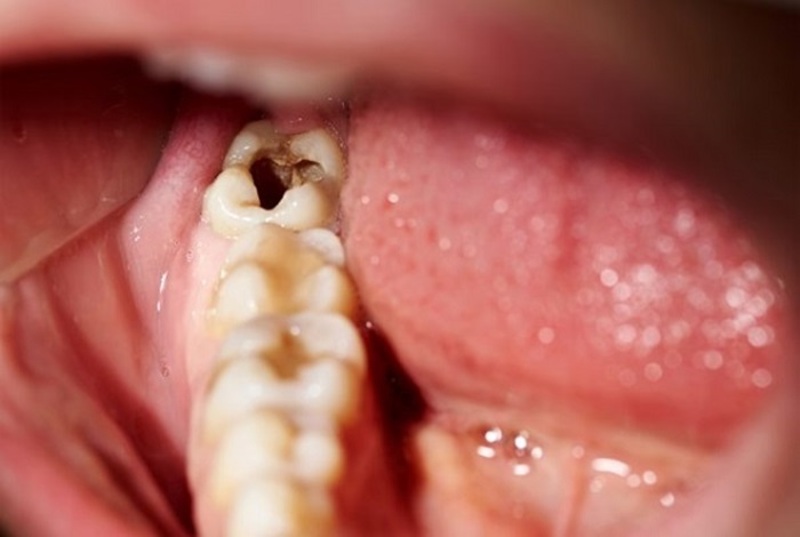 Sâu răng hoặc mẻ răng cũng gây ê răng khi ăn đồ nóng lạnh
