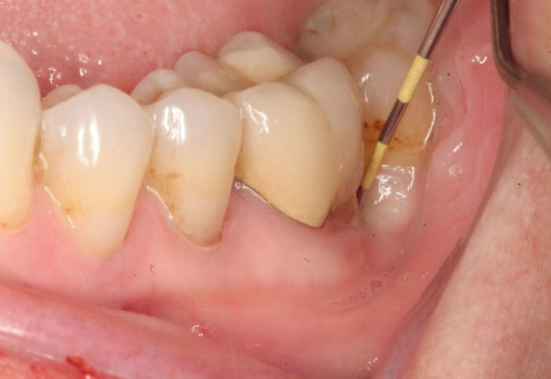 Sâu răng có mủ là tình trạng sâu răng diễn biến nặng, tiềm ẩn nhiều nguy cơ