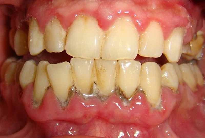 Mảng bám cao răng tích tụ lâu ngày cũng là nguyên nhân gây sâu răng