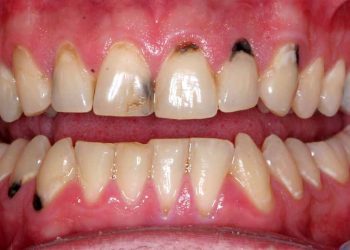 Tình trạng sâu răng cửa có thể gặp ở bất kỳ đối tượng người bệnh nào