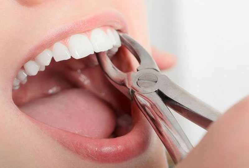 Trong trường hợp răng cửa bị sâu không còn khả năng bảo tồn bác sĩ sẽ chỉ định nhổ răng