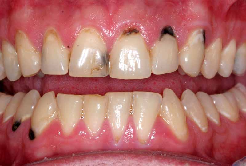 Tình trạng sâu răng cửa có thể gặp ở bất kỳ đối tượng người bệnh nào