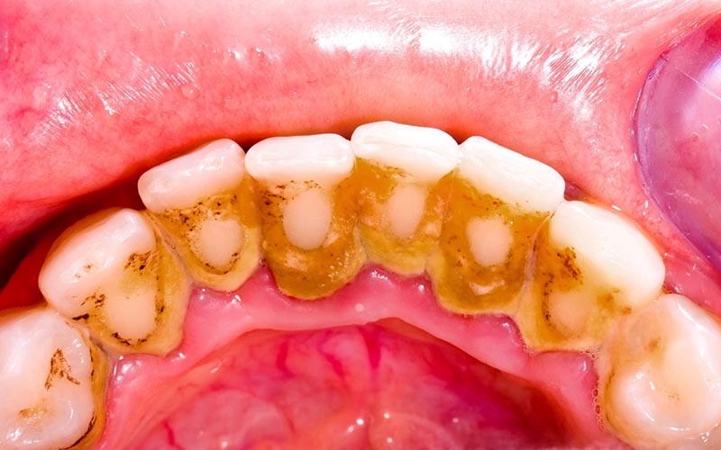Sâu răng hôi miệng xảy ra do sự tấn công của vi khuẩn vào khoang miệng