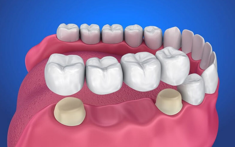 Bọc răng sứ là phương pháp điều trị sâu răng hôi miệng hiệu quả