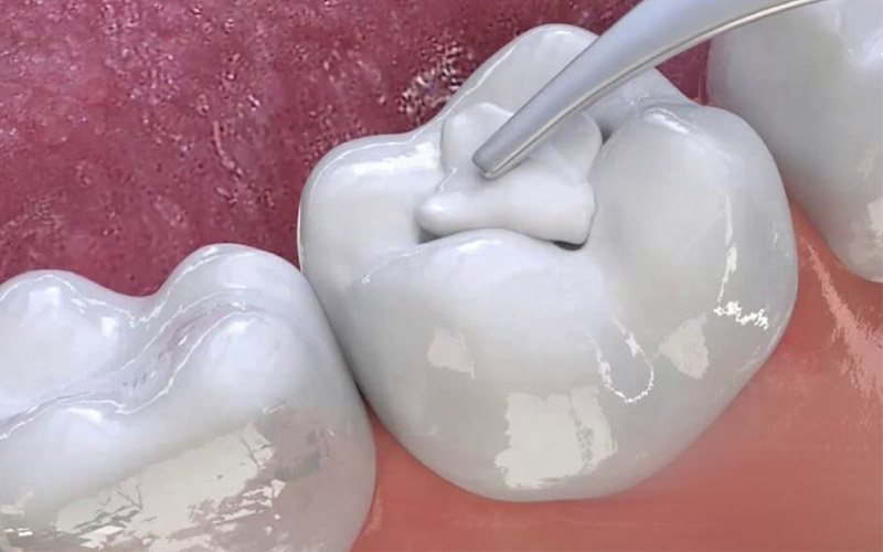 Trám răng là phương pháp thích hợp để trị bệnh lý sâu răng giai đoạn đầu