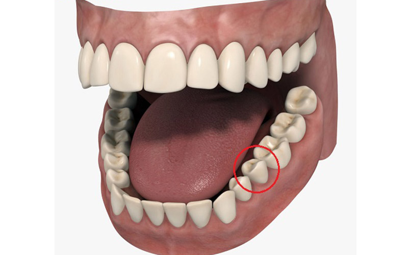 Răng số 5 được xếp vào nhóm răng tiền hàm