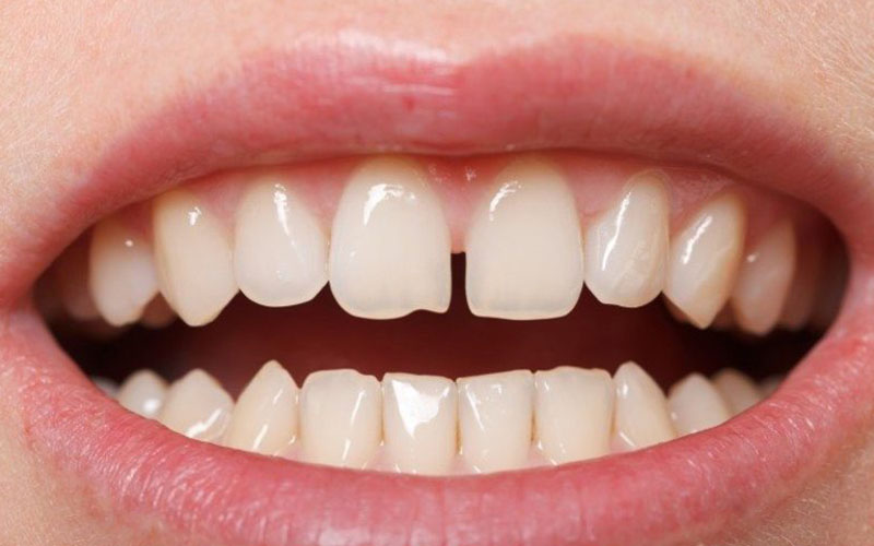 Độ thưa của các kẽ răng cũng có thể gây ra tình trạng sâu răng