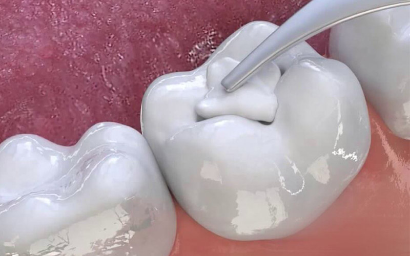 Trám răng là liệu pháp nha khoa được nhiều bệnh nhân thực hiện