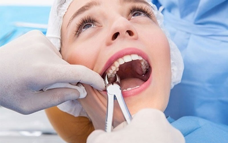 Khi bị sâu răng số 5 có nên nhổ hay không là vấn đề được nhiều người quan tâm
