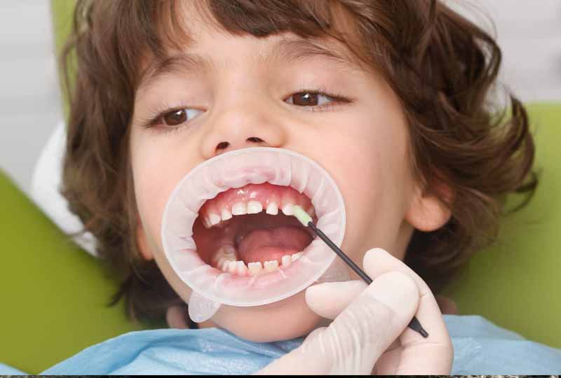 Tùy tình trạng sâu răng ở trẻ bác sĩ sẽ có chỉ định nha khoa phù hợp
