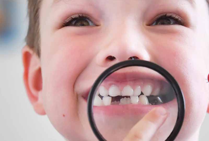 Sún răng ảnh hưởng nhiều đến sức khỏe răng miệng của trẻ