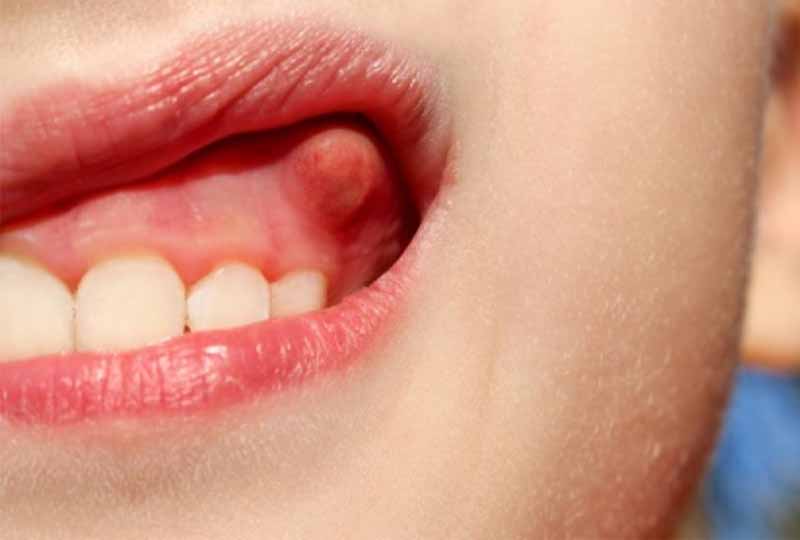 Áp xe răng ở giai đoạn khởi phát nên dùng thuốc điều trị dứt điểm