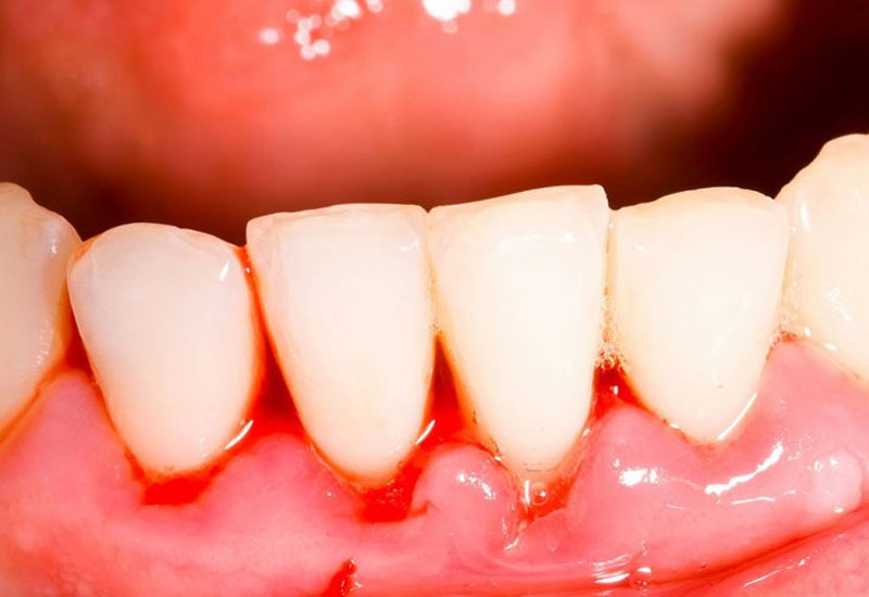 Viêm nha chu là bệnh lý răng miệng khá phổ biến, có thể gặp ở nhiều lứa tuổi khác nhau