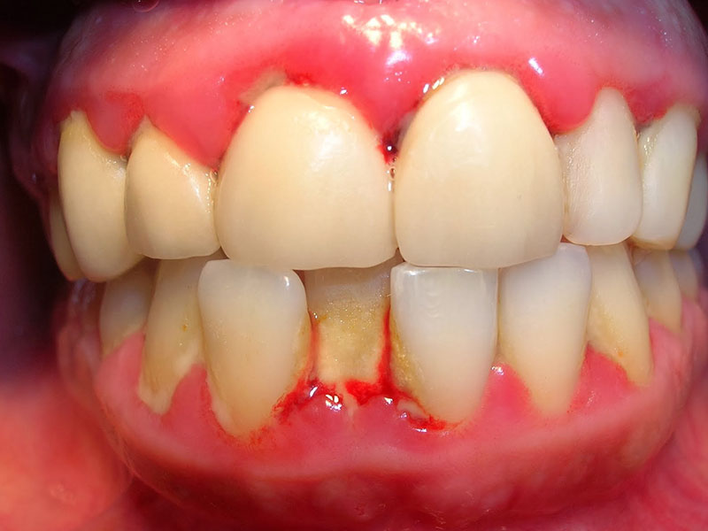 Bệnh viêm nha chu thường xảy ra do việc vệ sinh răng miệng không đúng cách