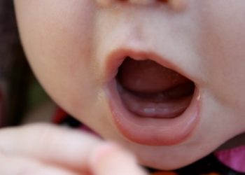 Trẻ trên 1 tuổi mà chưa mọc chiếc răng đầu tiên được coi là chậm mọc răng