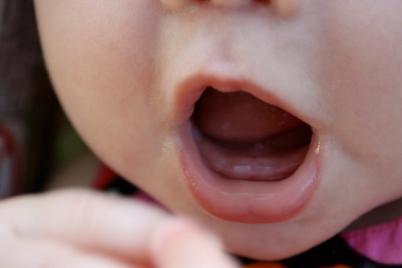 Trẻ trên 1 tuổi mà chưa mọc chiếc răng đầu tiên được coi là chậm mọc răng