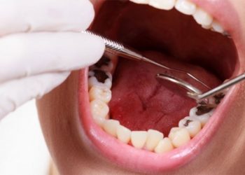 Chữa sâu răng nặng bằng cách nhổ bỏ, trồng răng mới