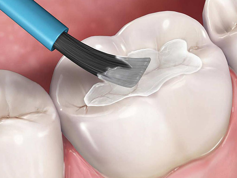 Trám răng là phương pháp thường được sử dụng phổ biến trong việc điều trị sâu răng