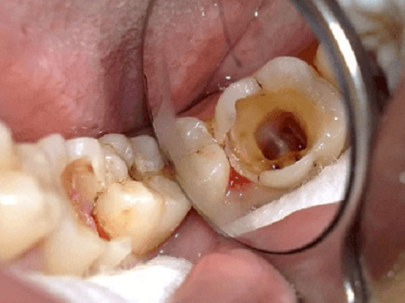 Sâu răng là tình trạng tổn thương mô cứng ở răng,