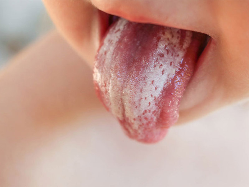 Chấm trắng xuất hiện ở đầu lưỡi chính là dấu hiệu hàng đầu nhận biết căn bệnh