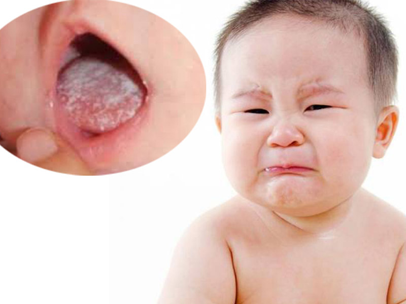 Bệnh tưa lưỡi ở trẻ nhỏ cần phải được điều trị kịp thời nếu không sẽ gây nhiều ảnh hưởng tới sức khỏe của bé